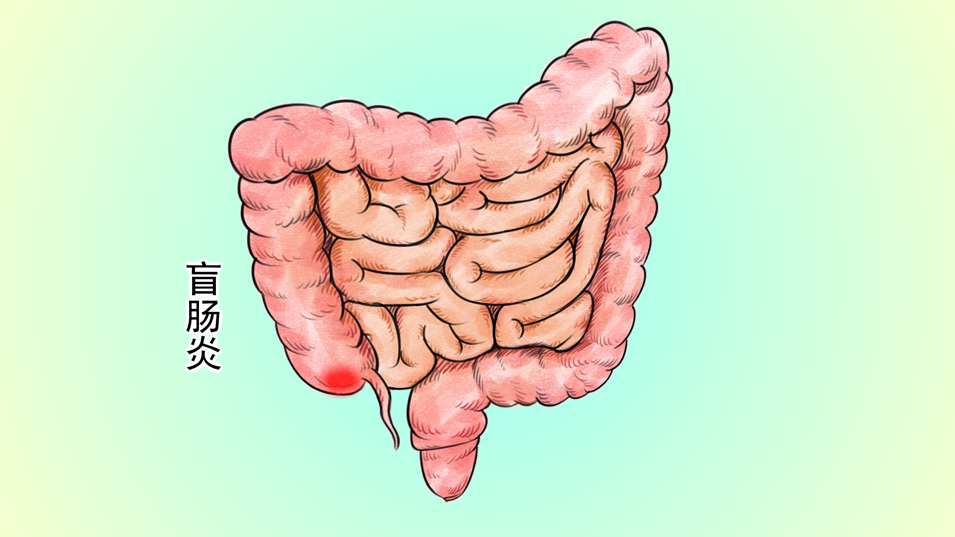 急性盲肠炎吃点什么食物_急性盲肠炎不及时治疗_急性盲肠炎避免吃