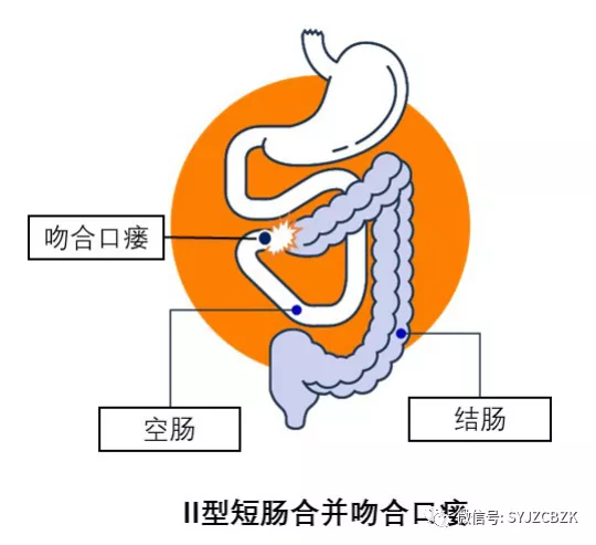 罗克恩病早期症状_克罗恩病治疗多少钱_罗克罗恩病