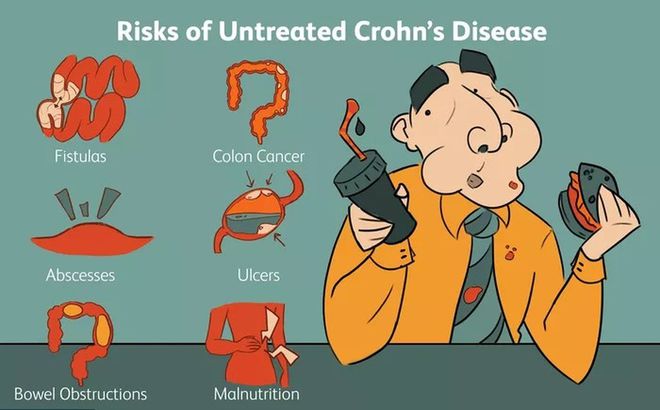 罗克恩病早期症状_罗克恩病严重吗_克罗恩病最常见的症状
