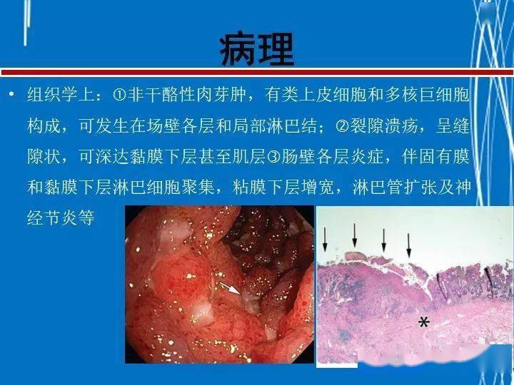 克罗恩病完整诊断_诊断克罗恩病的检查首选的是_克罗恩病理诊断