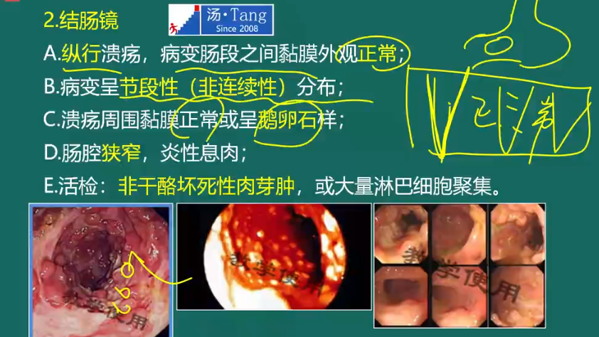 克罗恩肠炎能活几年_克罗恩肠炎跟一般肠炎的区别_克罗恩病吃肠炎宁会好转吗