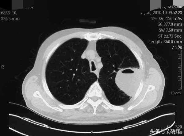 肺空洞是什么病_肺空洞病是不是传染病_肺空洞临床表现
