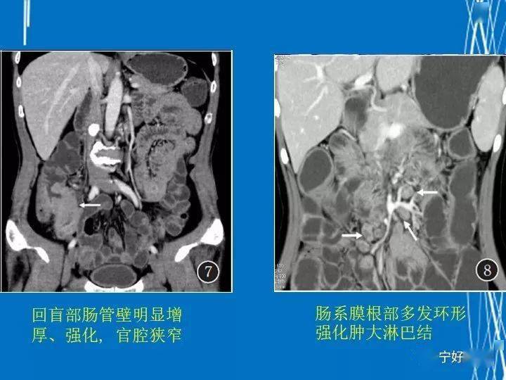 克罗恩病x线表现_克罗恩病病理报告样本_罗克罗恩病的特征性体征