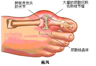 哪些原因会导致痛风的出现