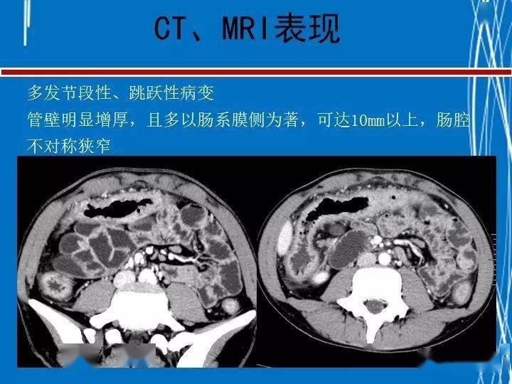 罗克恩病怎么确诊_克罗恩病完整诊断_诊断克罗恩的标准