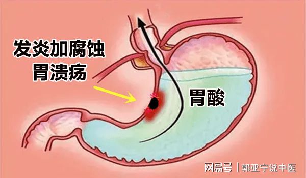 胃炎胃溃疡的中医治疗_胃中医治疗胃炎溃疡的方剂_胃中医治疗胃炎溃疡的方子