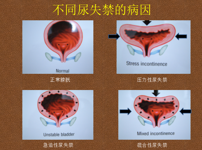 如何让肛门失禁_肛门失禁患者_肛门失禁的症状在临床