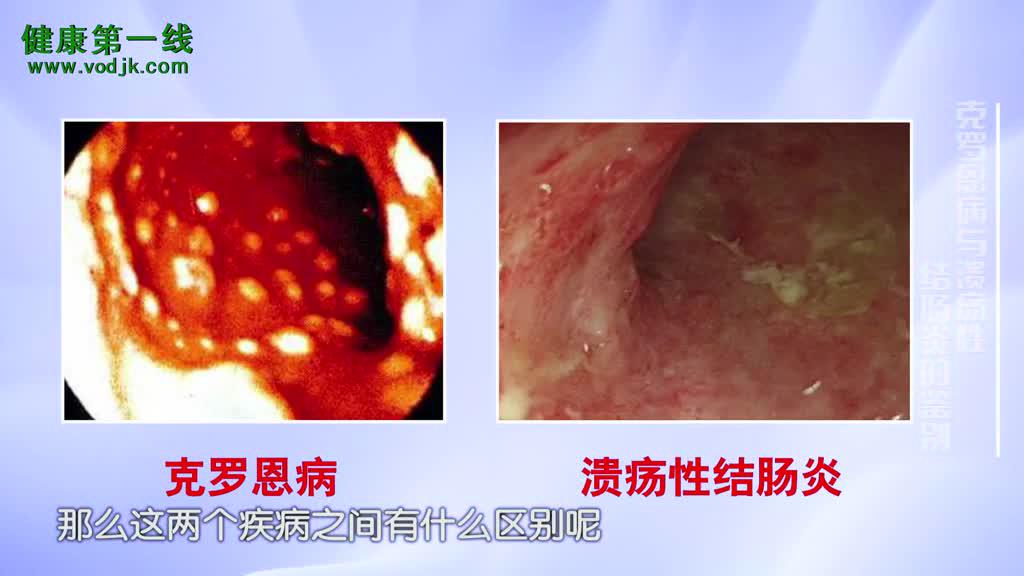 克罗恩病溃疡_克罗恩病溃疡能愈合吗_克罗恩病溃疡