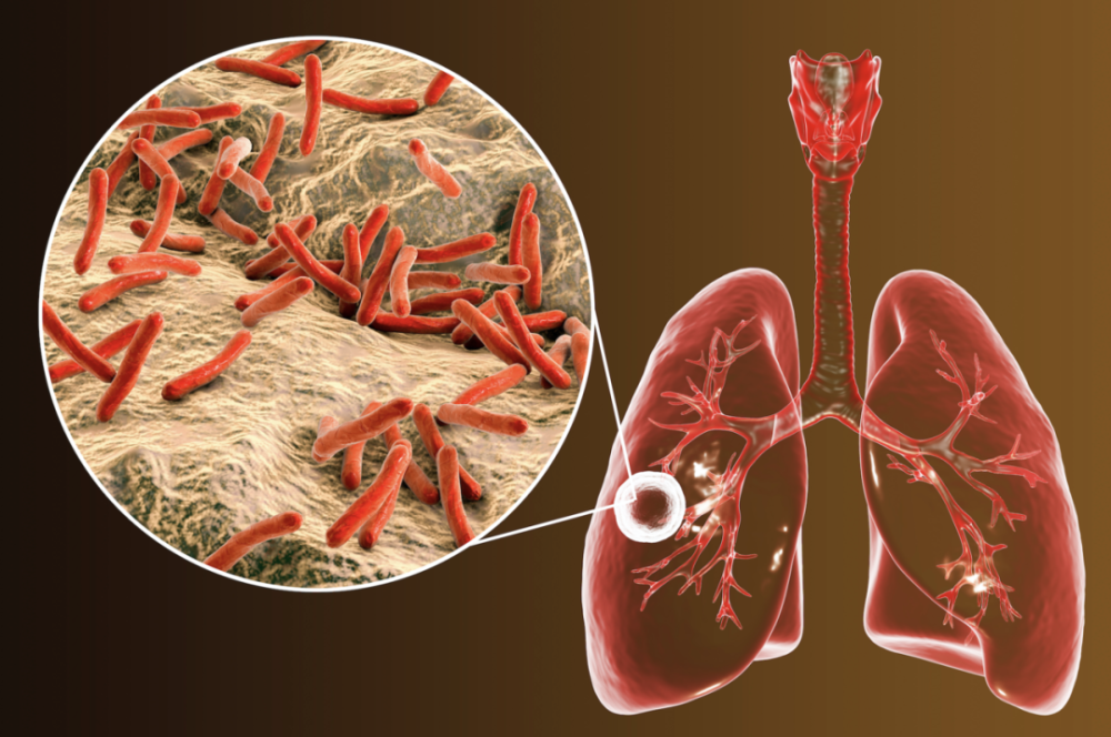 肺结核癌变_肺结核严重癌变会怎么样_肺结核严重了会癌变吗