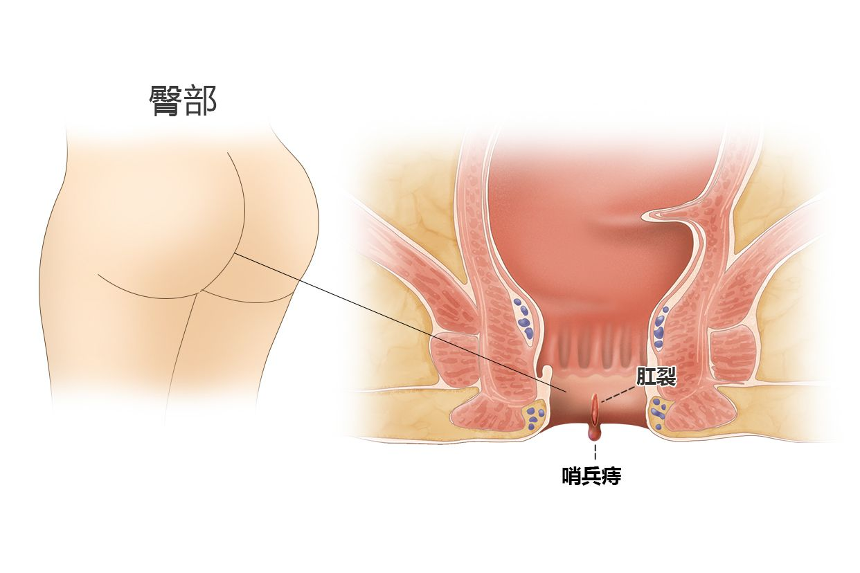 哨兵痔手术肛门处有刀口吗_哨兵痔手术后遗症_哨兵痔手术 肛门失禁 怎么办