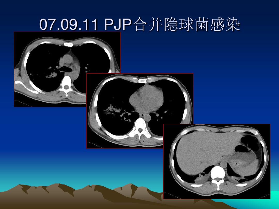 肺泡蛋白沉积症_肺泡蛋白沉积症并发症_肺泡蛋白质沉积症发病率