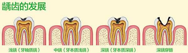 龋齿的发展