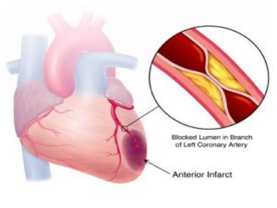 冠心病