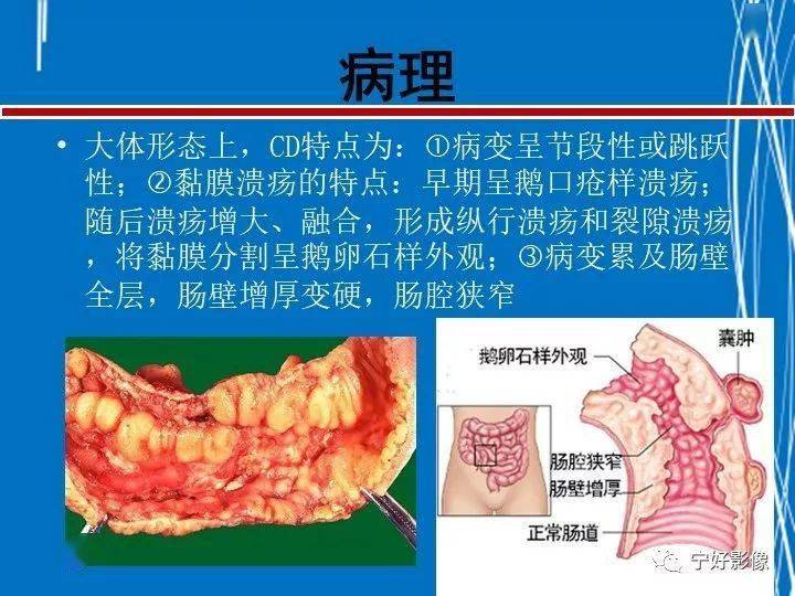 克罗恩病完整诊断_克罗恩病理诊断_诊断克罗恩病的检查首选的是