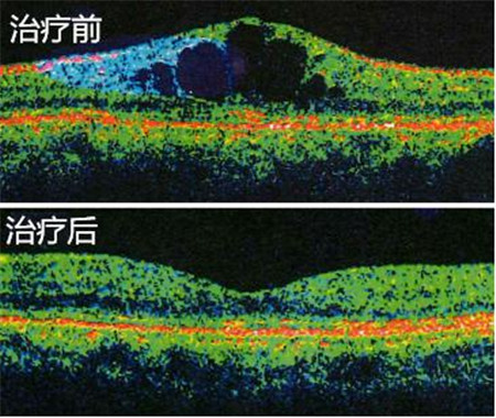 药物性青光眼可以治愈吗_药物相关性青光眼_药物治疗青光眼的原理