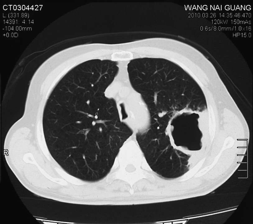 肺空洞临床表现_肺空洞是什么病_肺空洞病是不是传染病