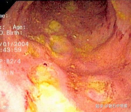 罗克罗恩病_克罗恩病治疗多少钱_罗克恩病早期症状