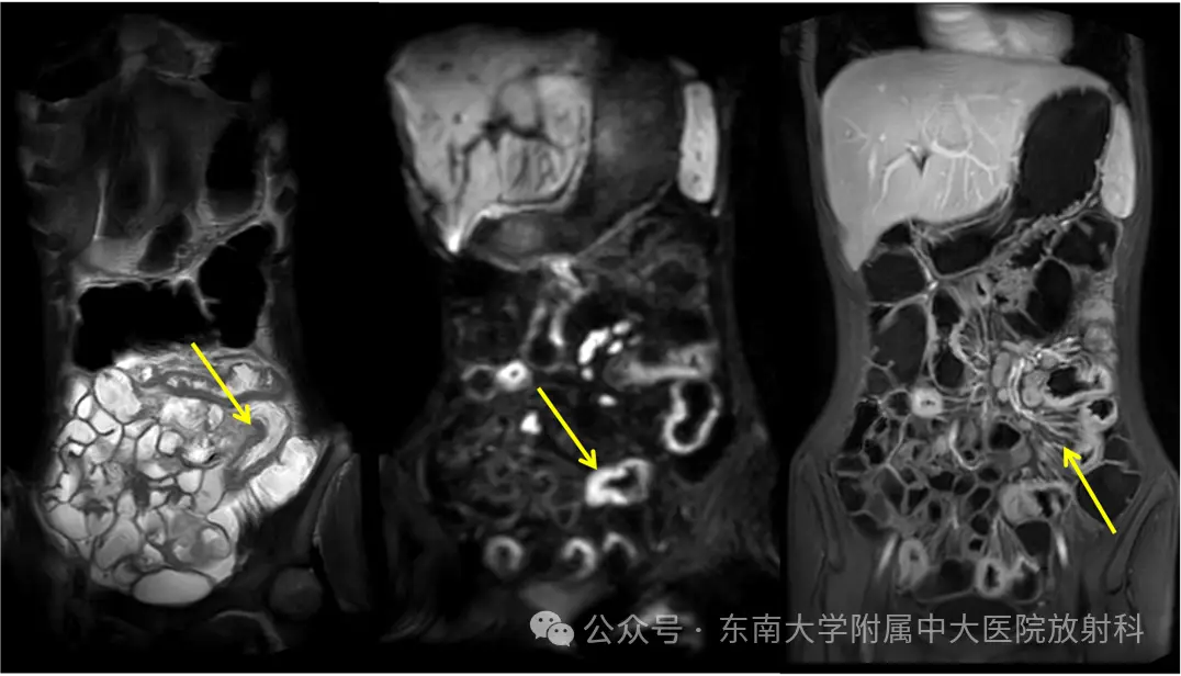 克罗恩治疗药物_罗克恩病能治好吗_罗恩克病