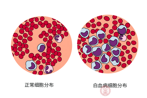 白血病化疗后能好吗_白血病做完化疗能活多久_白血病化疗后能活多久