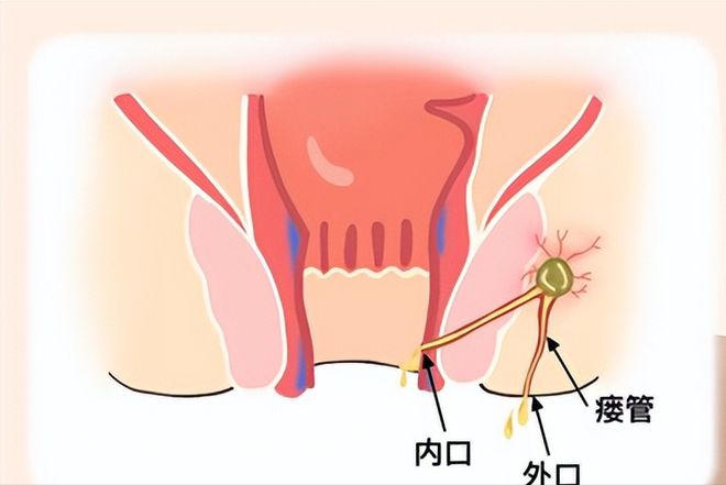 切除手术做肛瘘时间要多久_肛瘘切除术后一般几天可以出院_做肛瘘切除手术要多少时间