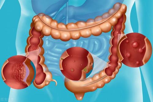 克罗恩病关节炎治疗_克罗恩病关节炎_克罗恩关节炎症指什么