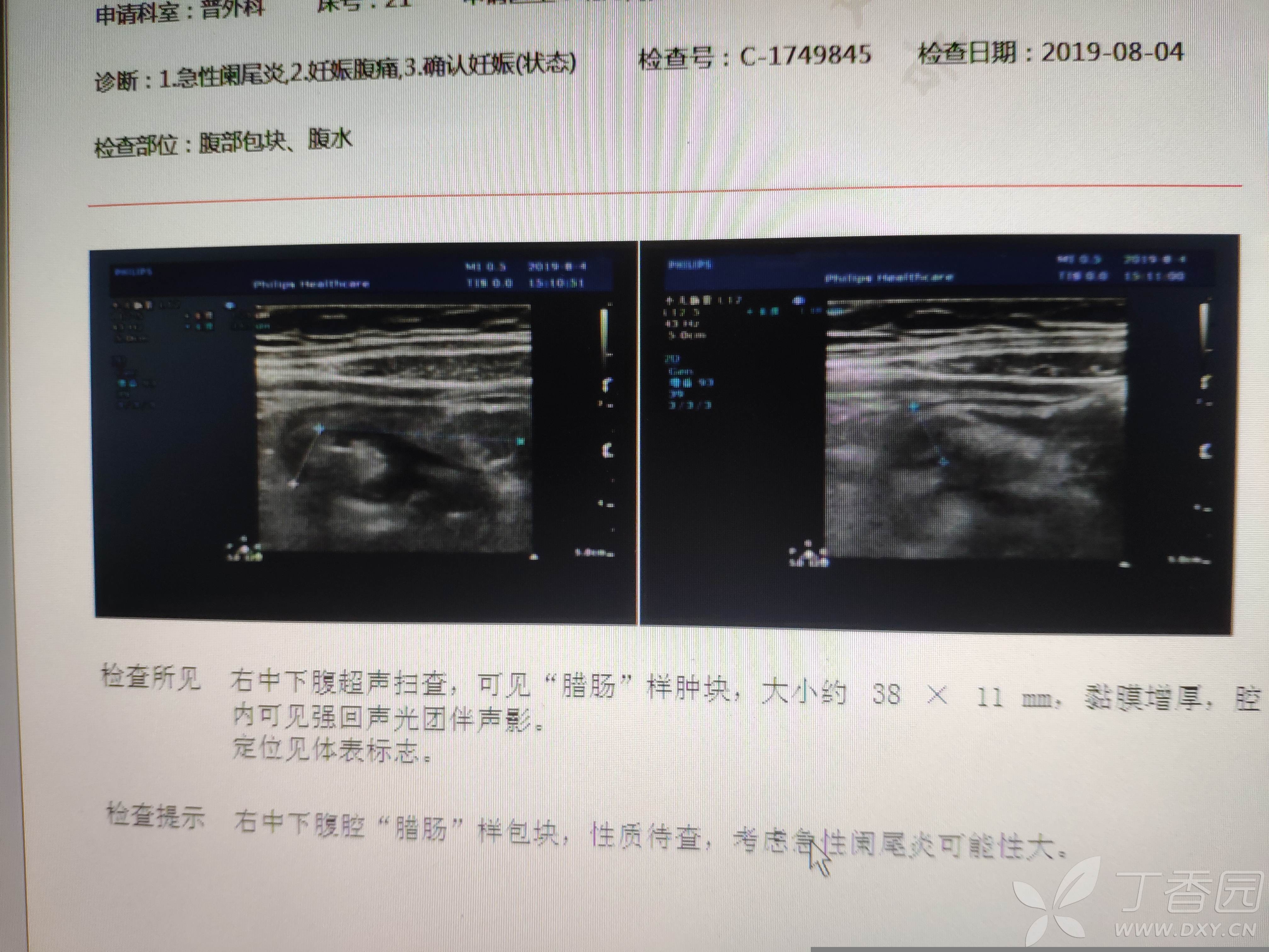 急性阑尾炎术后5个护理问题_急性阑尾炎术后护理要点是什么_急性阑尾炎手术后的护理