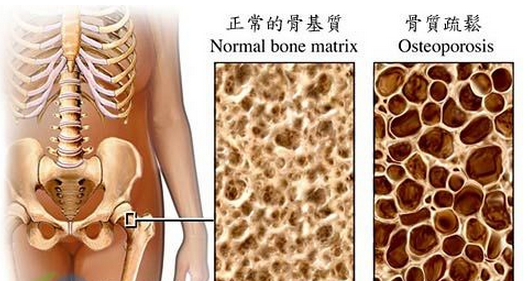 骨质疏松