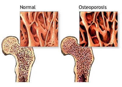 骨质疏松