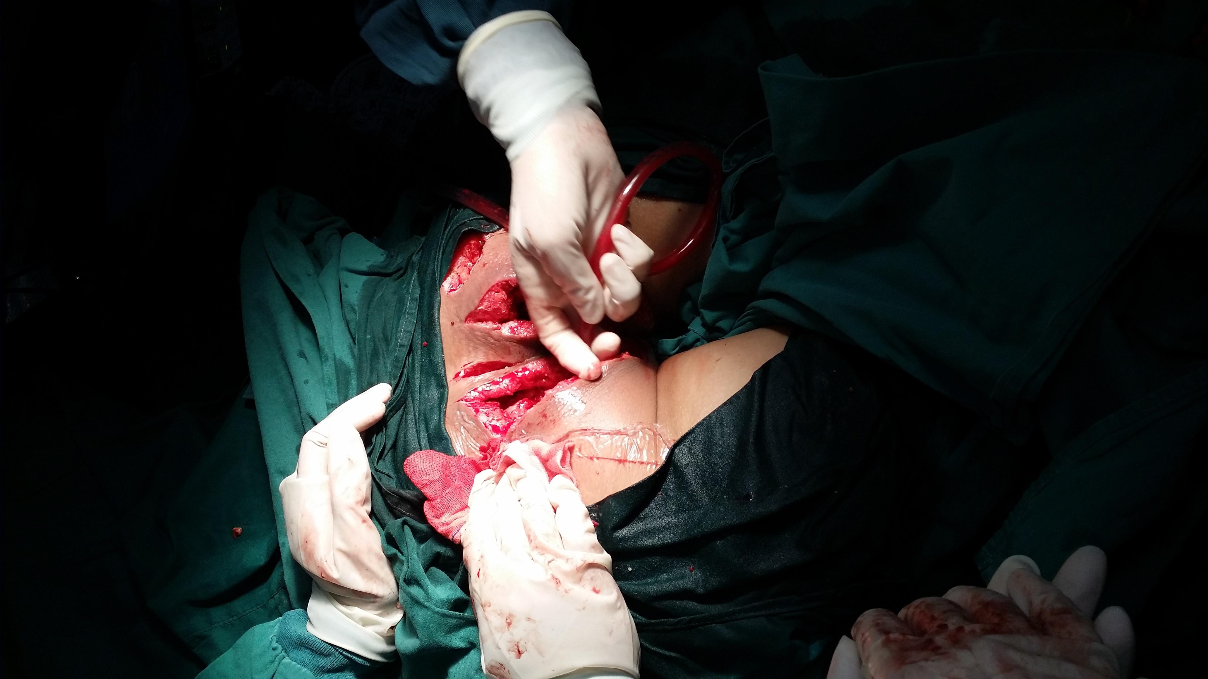 肛瘘手术 长时间流脓_手术长流脓肛瘘时间长吗_肛瘘术后流脓要流多久