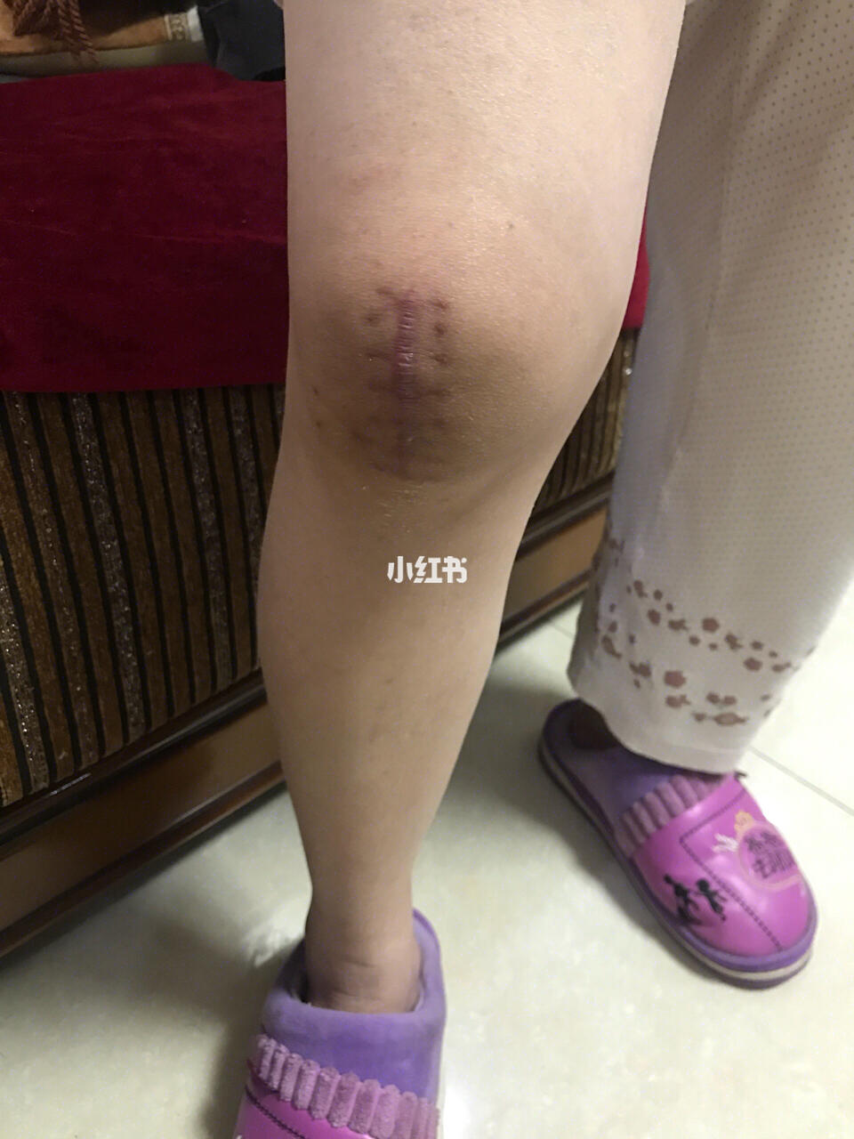 肛门手术失禁怎么回事_肛门失禁手术_肛门手术后失禁