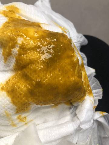 宝宝咳嗽有肺炎有后遗症吗_咳嗽症状肺炎宝宝有什么表现_宝宝咳嗽肺炎什么症状有哪些