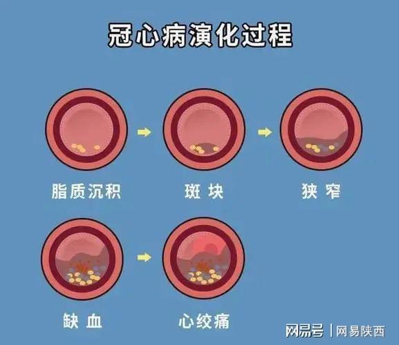 冠心病人护理措施_冠心病护理措施_护理冠心病措施有哪些