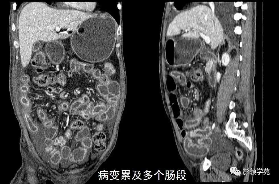 克罗恩病理诊断_克罗恩病完整诊断_诊断克罗恩的标准