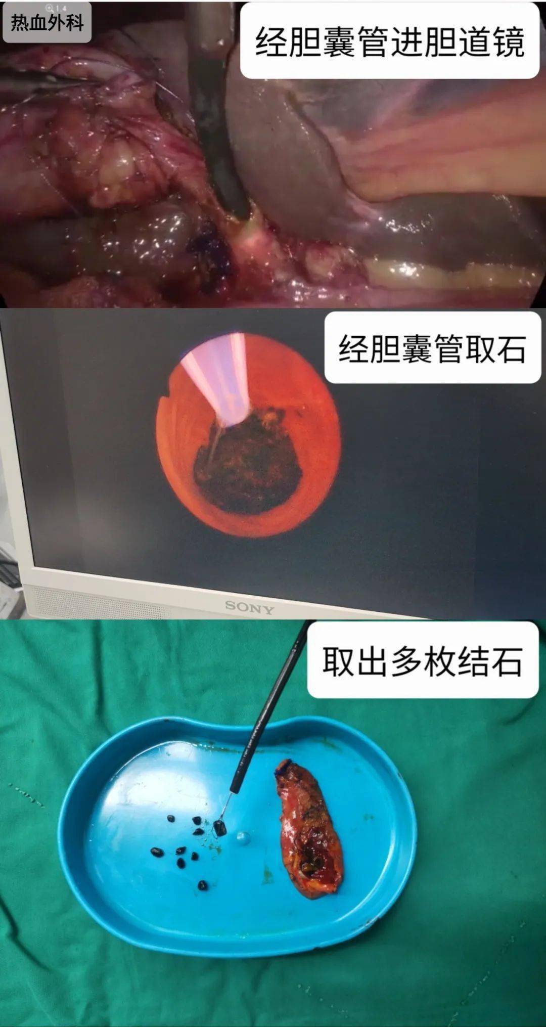 罗克罗恩病_罗恩病的症状_克罗恩病内镜图片
