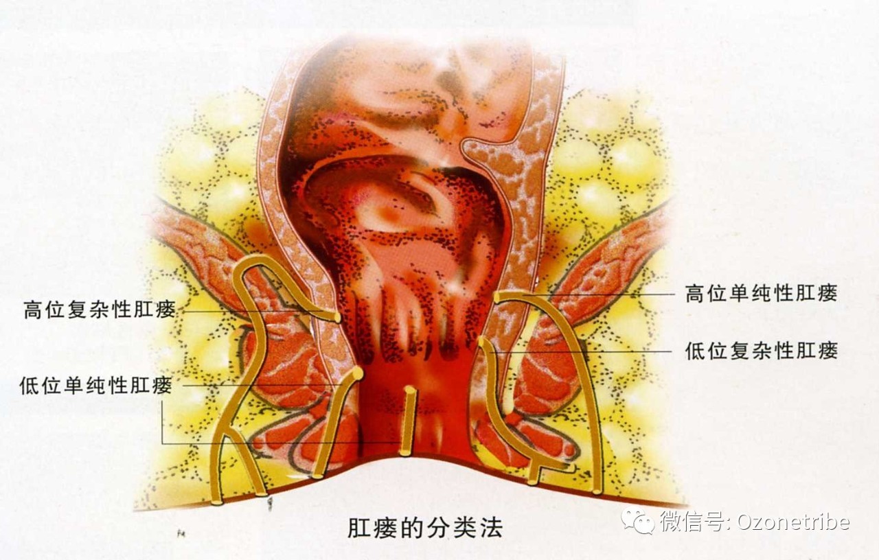 注射肛门大小失禁会臭氧流出吗_肛门注射臭氧可治疗什么病_臭氧从肛门注射 会大小便失禁吗