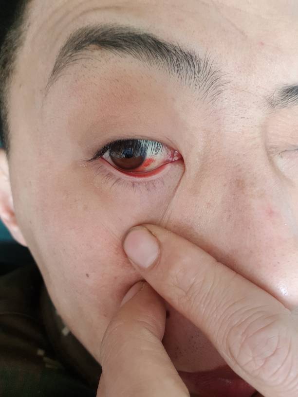 婴儿眼睛白眼球发蓝_婴儿的眼睛白眼球是蓝色的_婴儿白眼球有点蓝