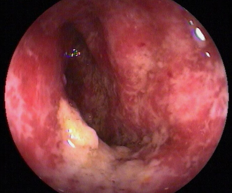 克罗恩病 ct_罗克罗恩病_罗克恩病严重吗