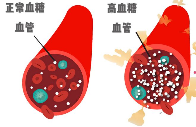 血压高冠心病_得了冠心病高血压能活几年_高血压冠心病能除根吗