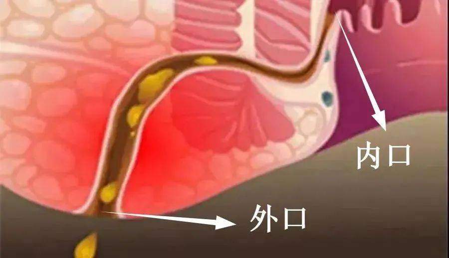 肛瘘手术后多久可以性l生活_肛瘘手术多长时间能过性生活_肛瘘手术多久能同房男