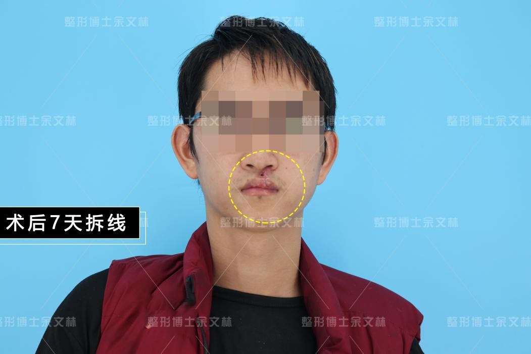 唇裂术后哭闹会伤口裂开吗_唇裂术后感冒咳嗽怎么办_咳嗽嘴唇干燥怎么办