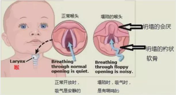 儿童支气管肺炎常用药_儿童支气管肺炎的用药_儿童支气管肺炎治疗