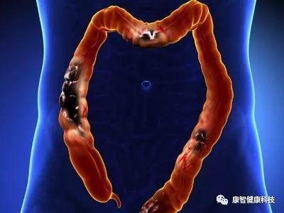 大便时拉出血来_拉大便拉出鲜血_拉大便时只拉出鲜血