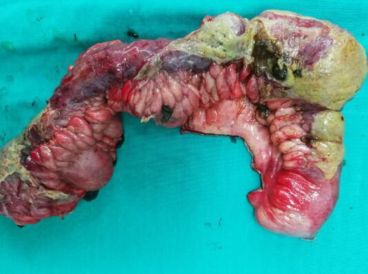 克罗恩病护理个案_克罗恩病潜在并发症的护理措施_克罗恩病并发症的护理
