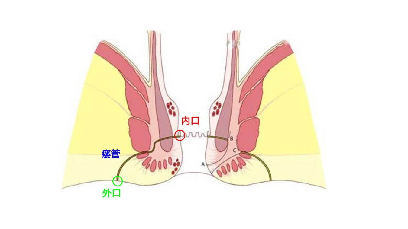 女人肛瘘手术_女性肛瘘手术时间_手术女性肛瘘时间多长