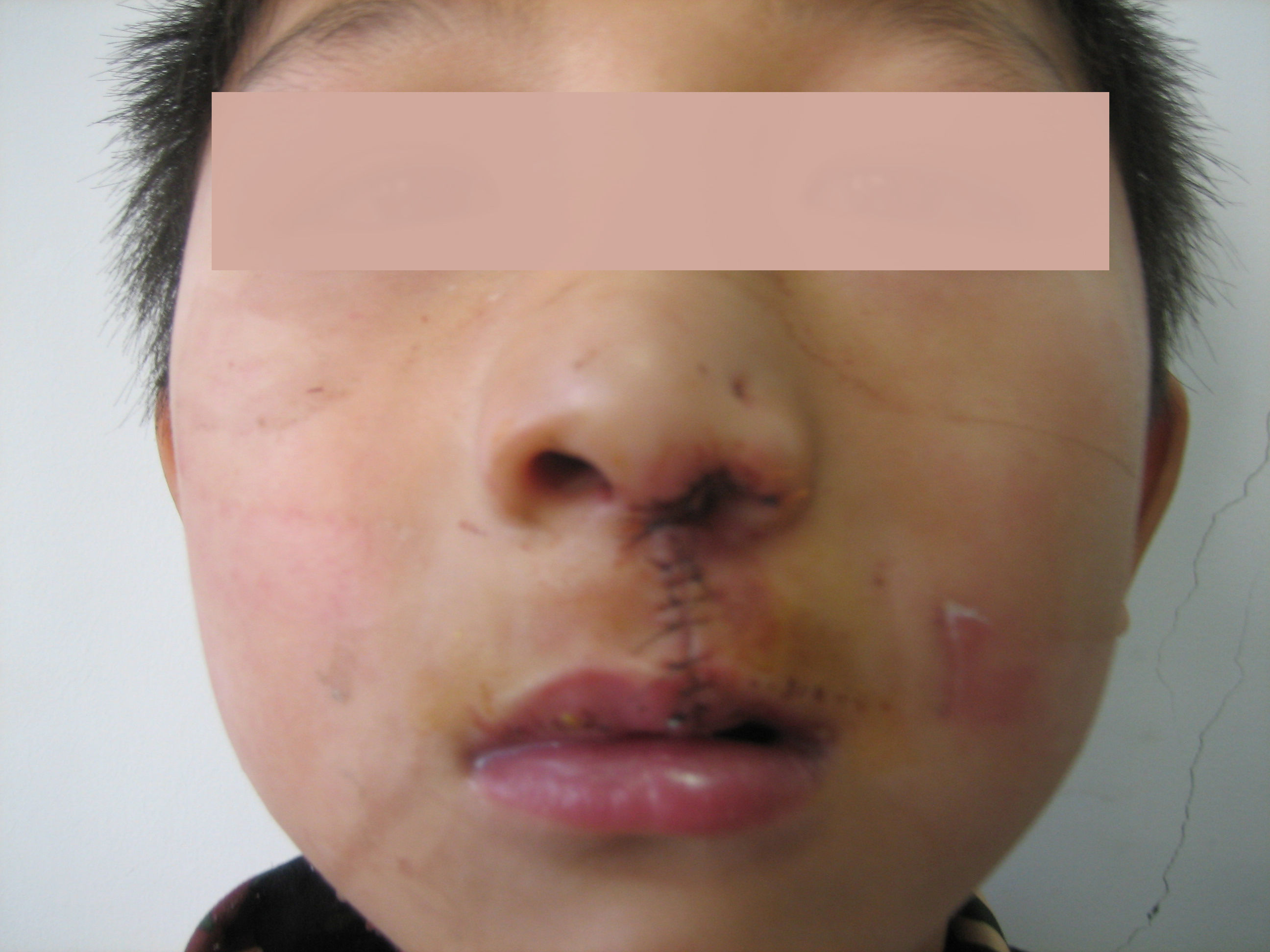 咳嗽嘴唇干裂吃什么药_唇裂术后感冒咳嗽怎么办_咳嗽后嘴唇干是什么原因