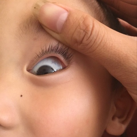 婴儿眼睛白眼球发蓝_婴儿的眼睛白眼球是蓝色的_婴儿白眼球有点蓝