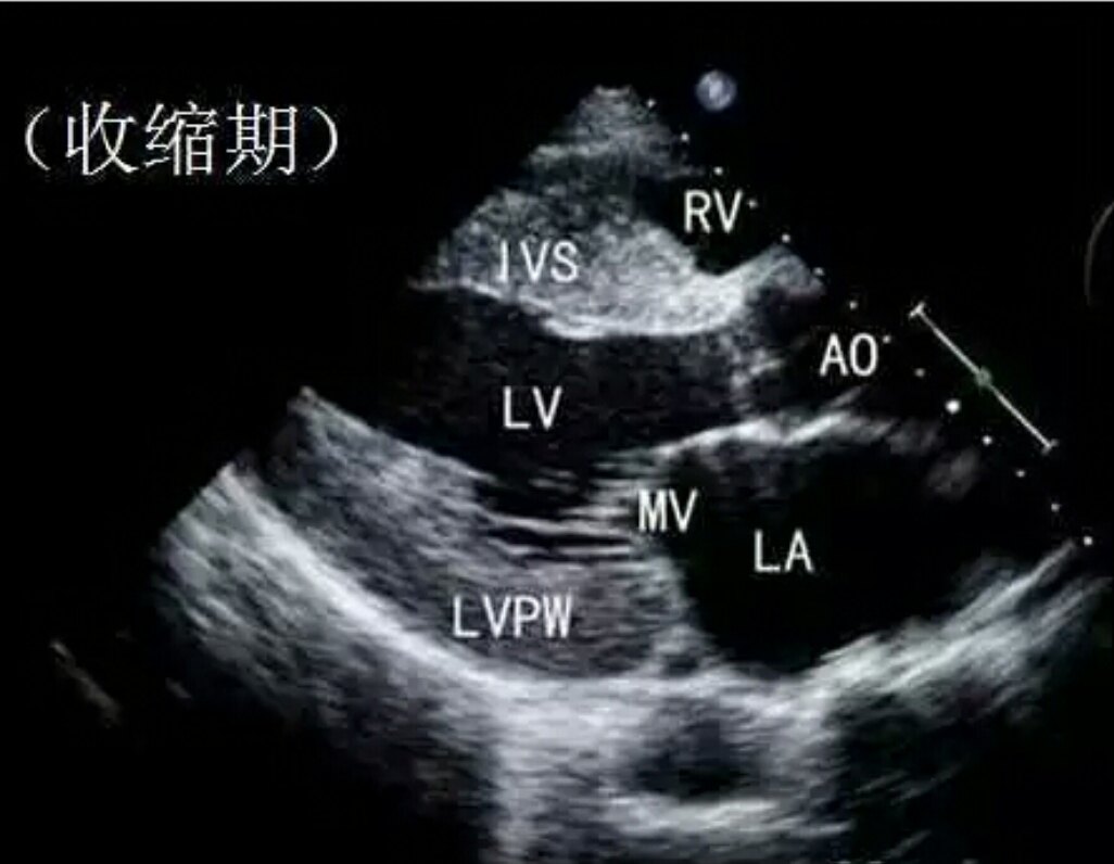 血压冠心病区别高压低压_血压冠心病区别高还是低_高血压和冠心病的区别