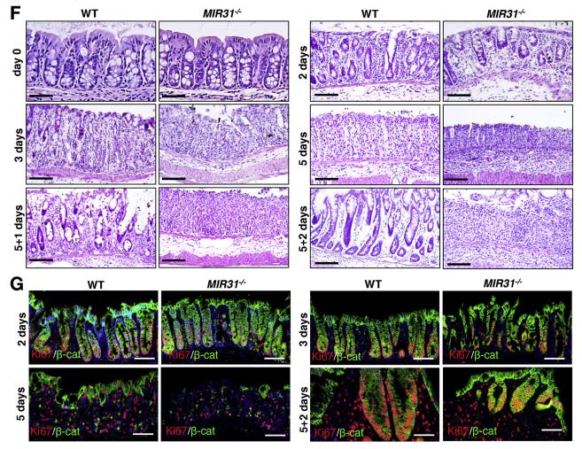 肠炎克罗恩病_克罗恩肠炎吃什么好_克罗恩吃肠炎宁有用吗