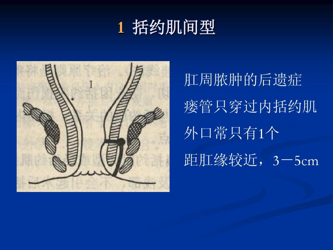 低位肛门手术失禁肛瘘图片_低位肛瘘手术肛门失禁_低位肛瘘切除术术后疼吗