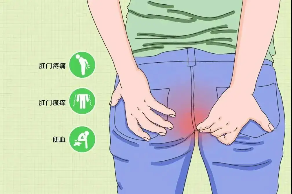 痔疮 肛瘘手术时间_手术痔疮肛瘘时间多长_痔疮肛瘘手术后几天能正常大便